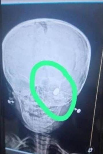 وفاة طفلة برصاصة طائشة في ريف البوكمال