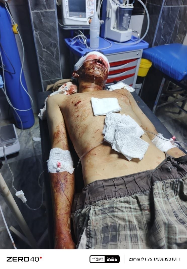 إصابة أربعة مدنيين بانفجار لغم من مخلفات الحرب شمال دير الزور